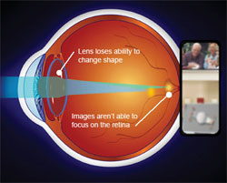 Presbyopia