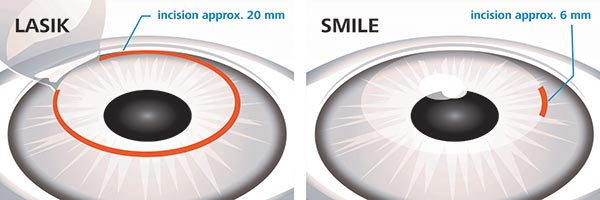 SMILE EYE SURGERY VS LASIK