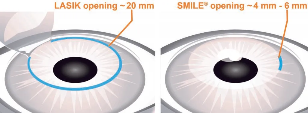 LASIK-&-SMILE-Side-by-Side-Graphic