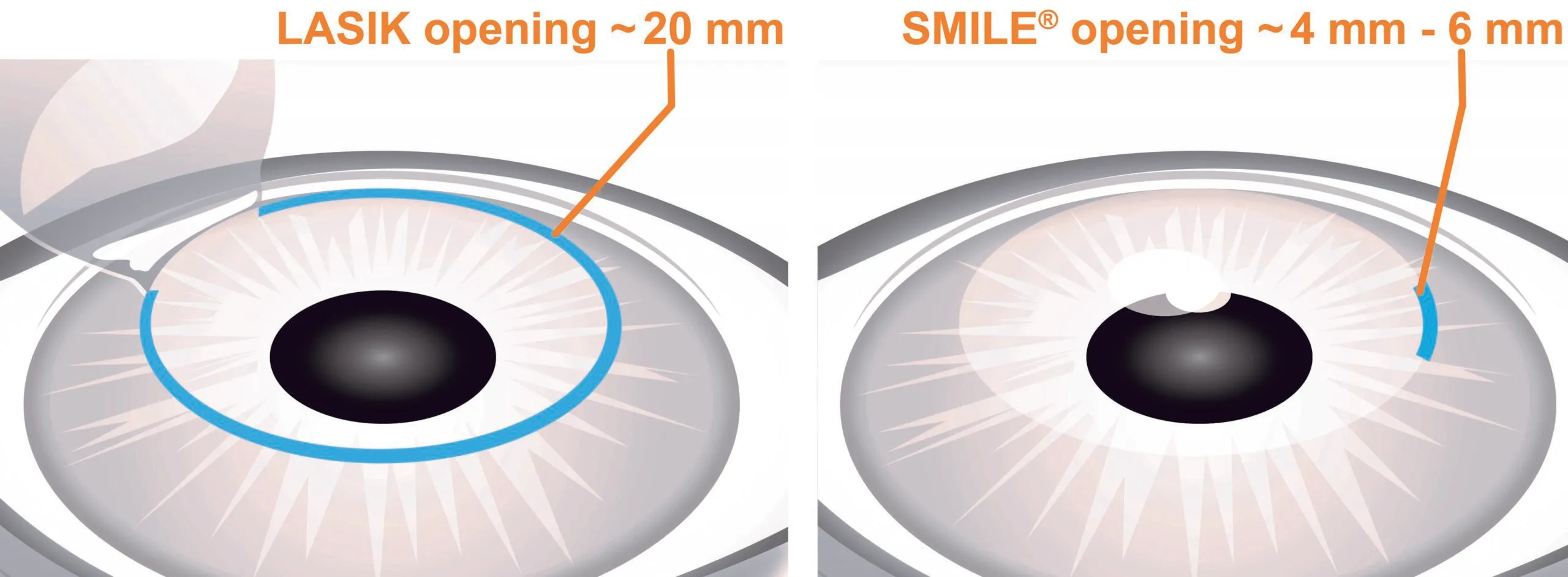 SMILE vs LASIK Eye Surgery